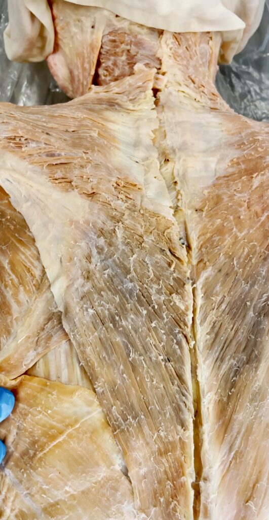 Traps on a skinless cadaver